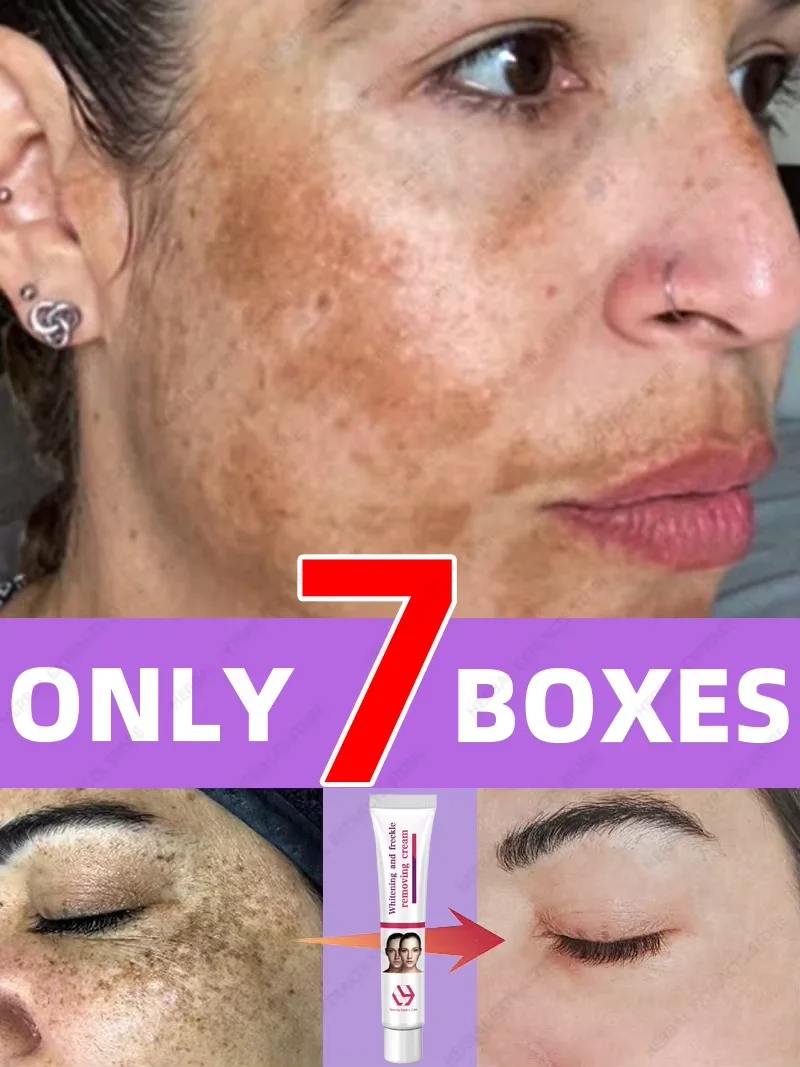 Powerful Cream Fast Skin Lightening Solve Melasma Dark Spots